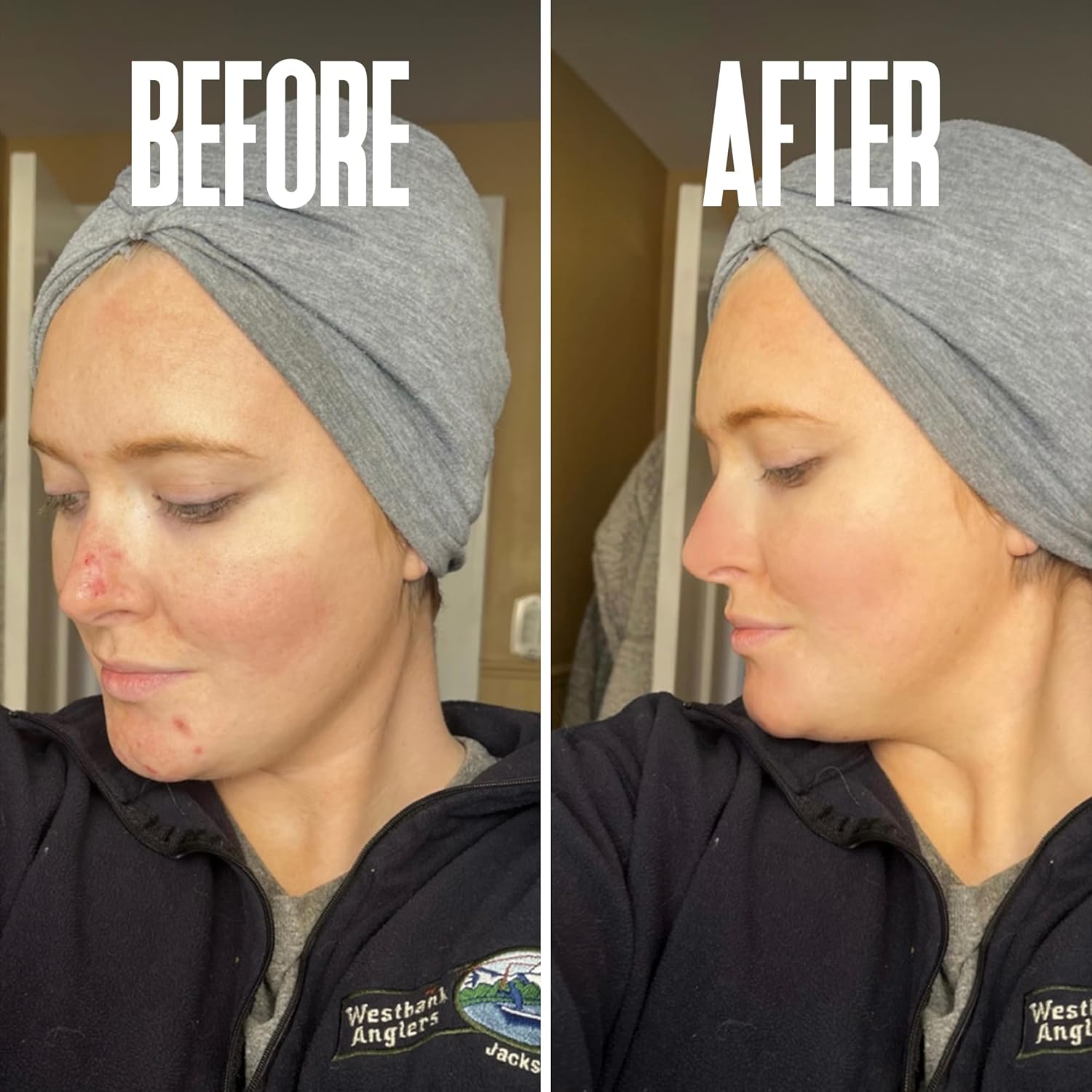 Glycolic Acid Peel 40% Professional Chemical Peel for Face for Acne Scars, Collagen Boost, Wrinkles, Fine Lines - Alpha Hydroxy Acid Liquid Exfoliant for Face Peel Mask for Men & Women