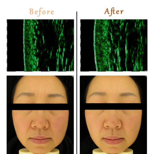 led face mask light therapy led mask red light IR photon skin rejuvenation